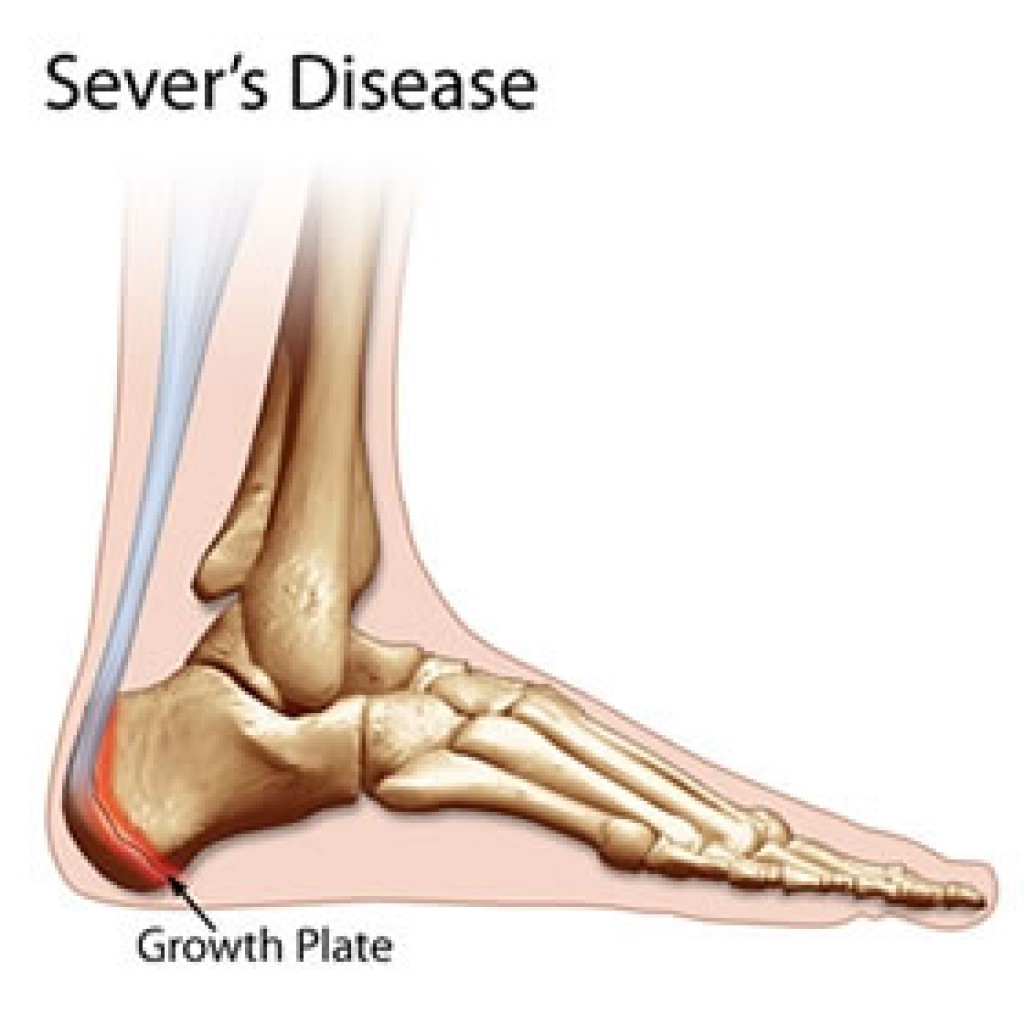 The Podiatry Group: Heel Pain/ Sever's 
